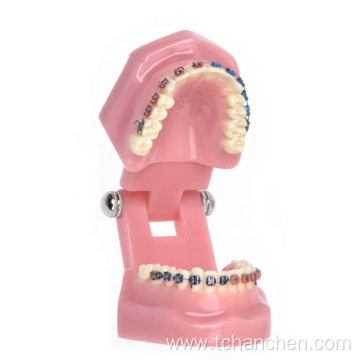 Orthodontic Model With Metal Bracket Wires Affixed